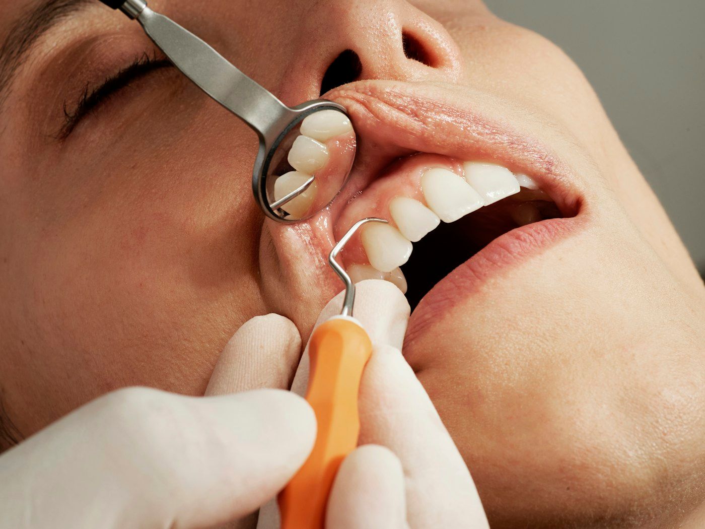 Smile Makeover (Digital Smile Design)